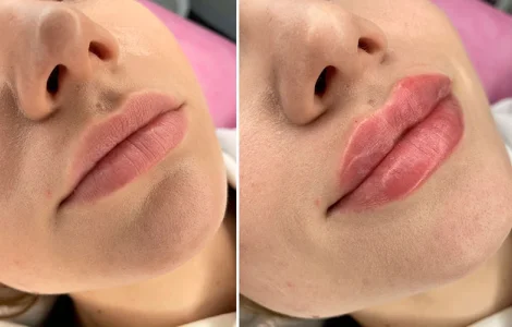 Контурування губ у мікрорайоні Солом'янка - зволоження і збільшення