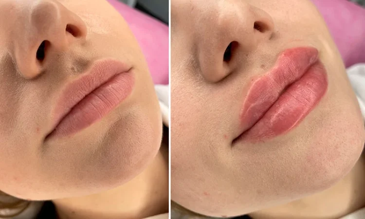 Контурирование губ в Киеве – увлажнение и увеличение - фото № 1