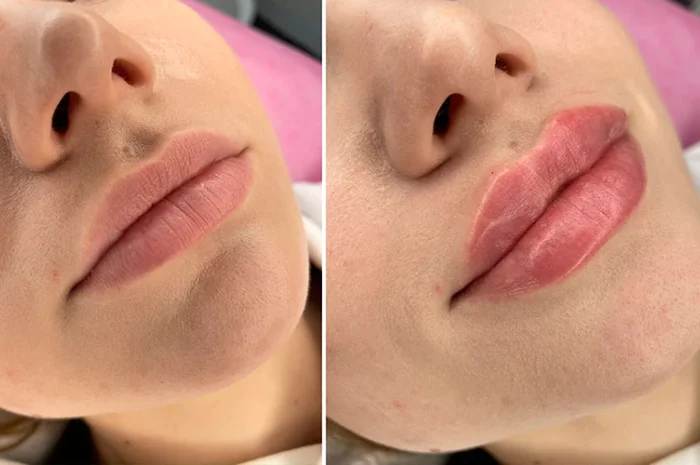 Контурирование губ в Киеве – увлажнение и увеличение- фото № 1